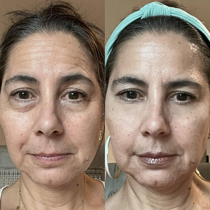 LumiLift™ | Under-Eye Red Light Therapy