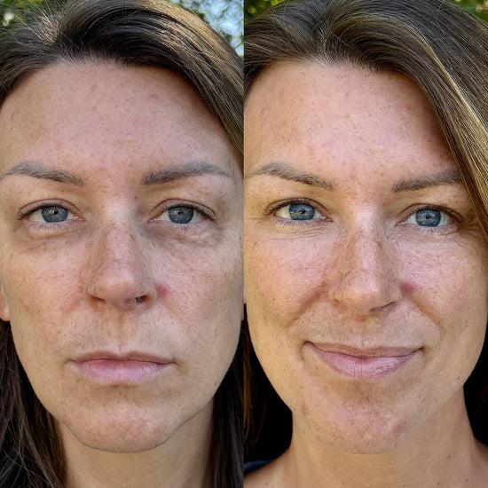 LumiLift™ | Under-Eye Red Light Therapy