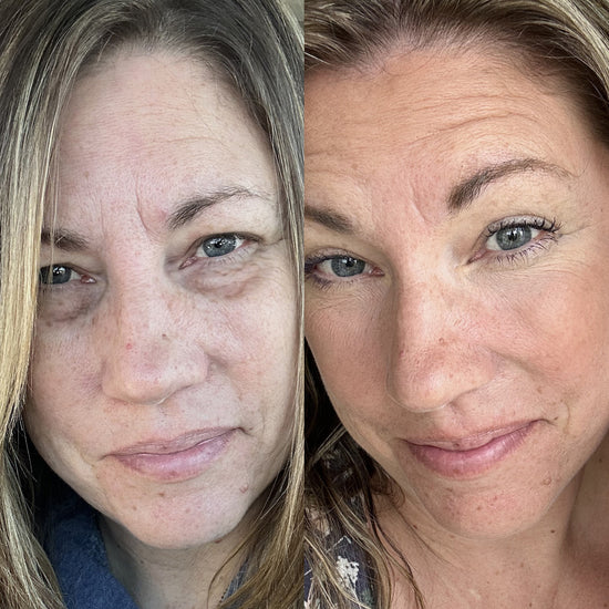 LumiLift™ | Under-Eye Red Light Therapy